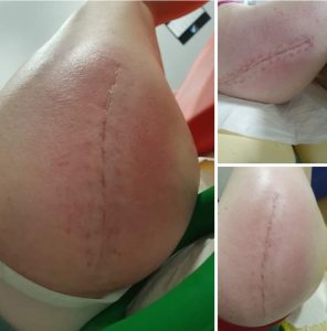 Rehabilitacja blizny Piaseczno Stara Miłosna Warszawa