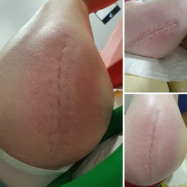 Rehabilitacja blizny PIaseczno Stara Miłosna Warszawa Rehabilitacja blizny PIaseczno Stara Miłosna Warszawa